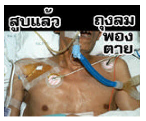 Thailand 2006 Health Effects mouth - emphysema, lived experience